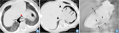 Case Report: Gas in the esophagus, stomach wall and portal vein with congenital hypertrophic pyloric stenosis